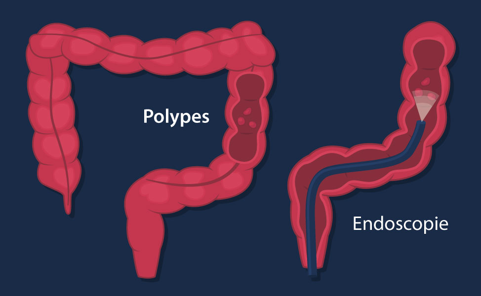 polypes et endoscopie
