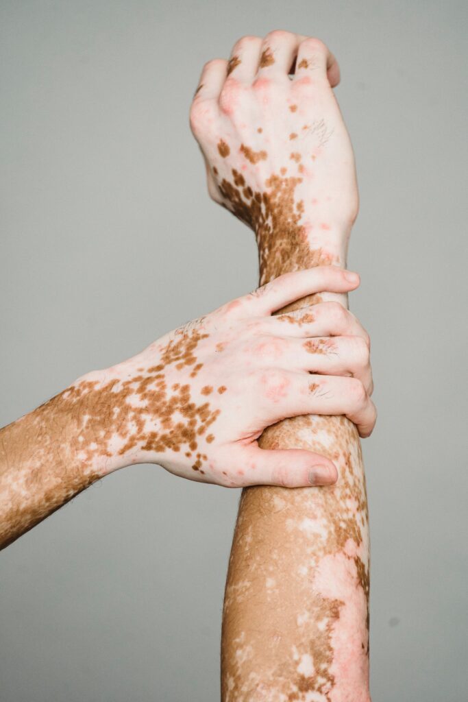 soigner le vitiligo avec le soleil