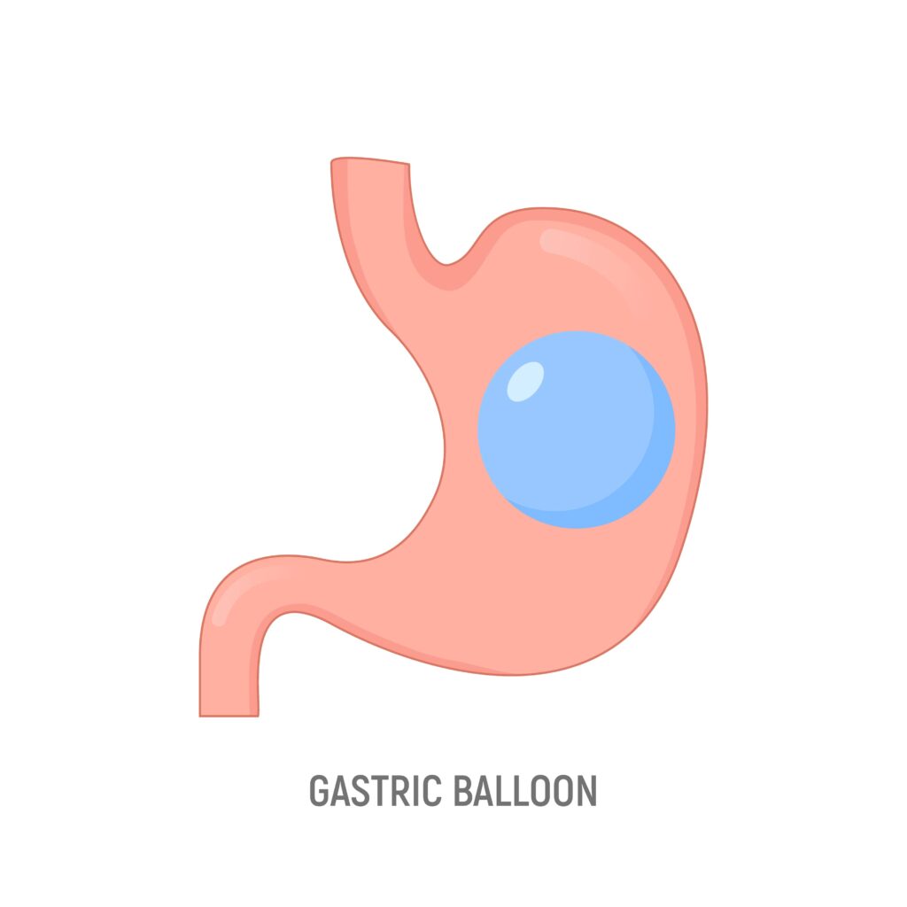 intra-Gastric balloon