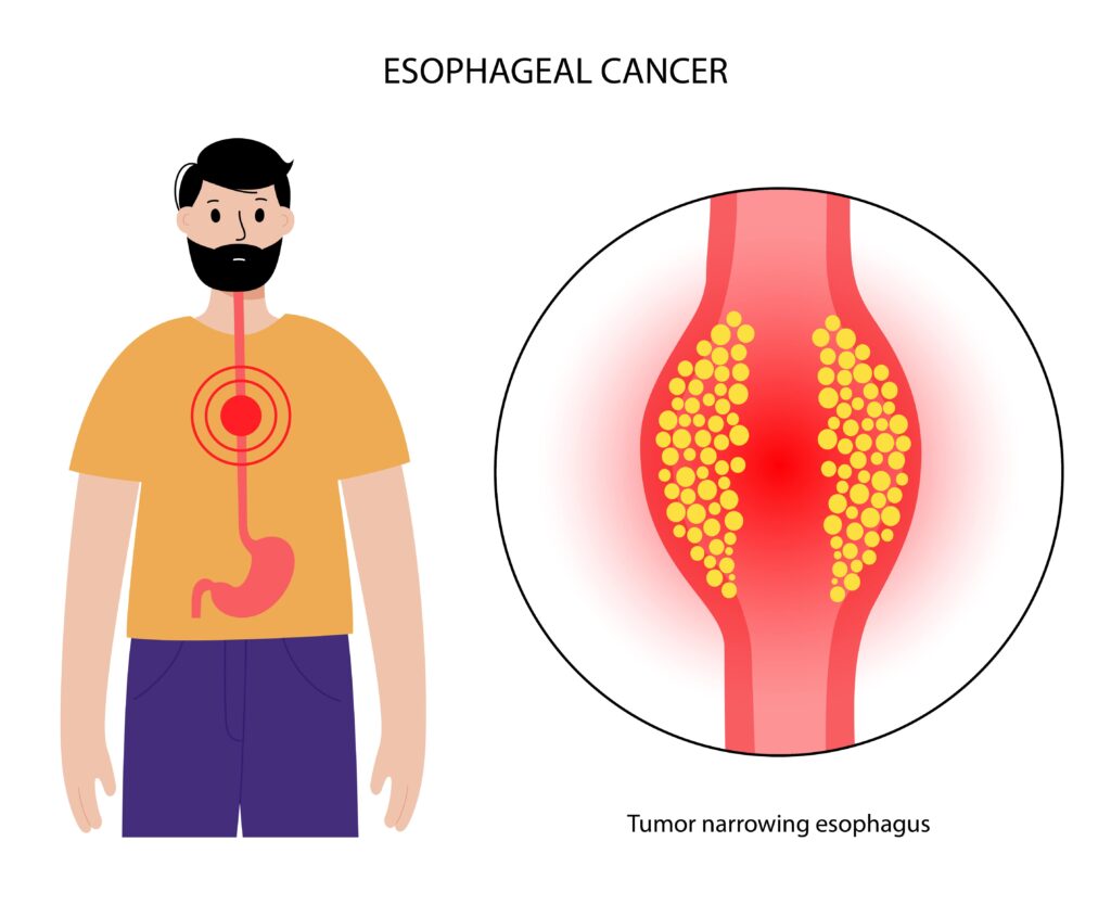 cancer oesophage