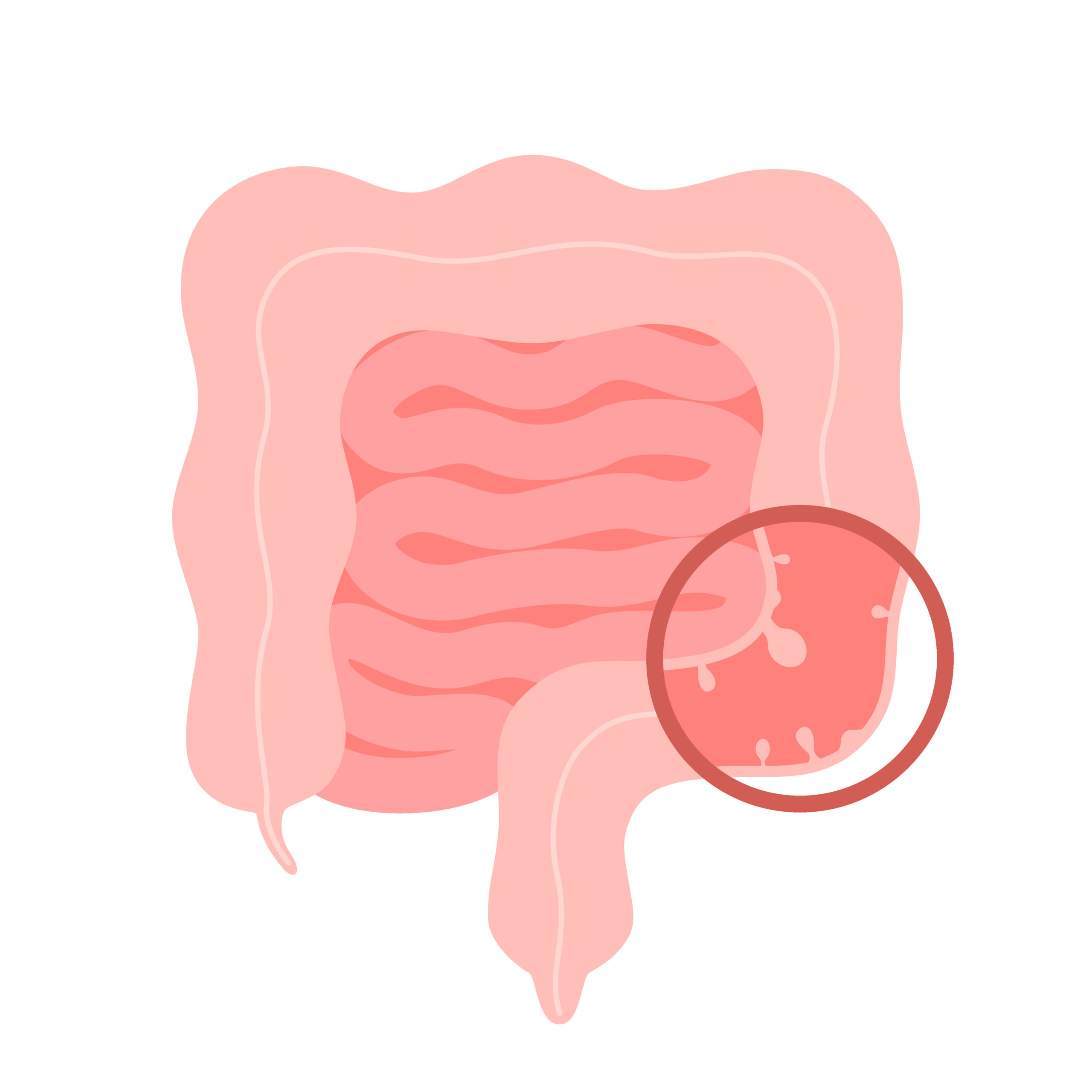 Polypes intestinaux : causes, traitements et prévention