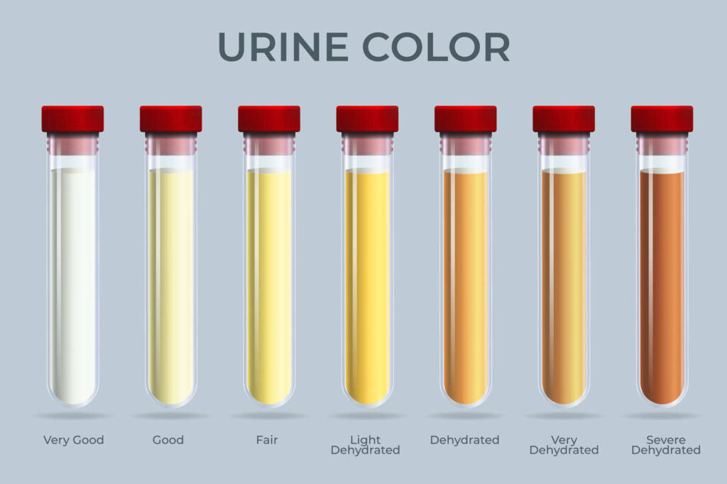 couleur urine qui sent fort