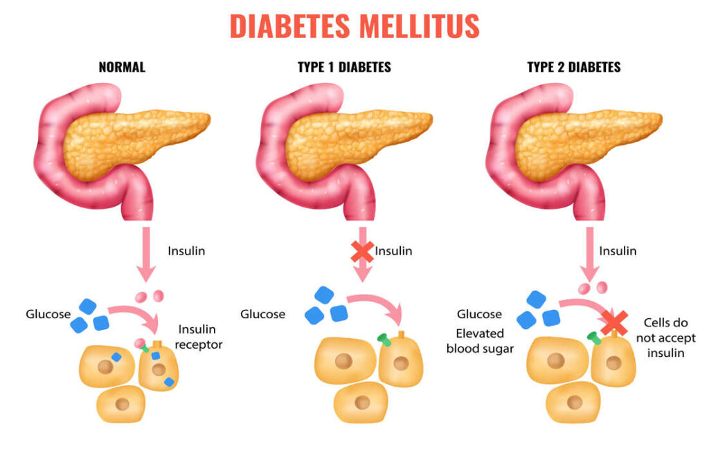 diabète et Pancréas